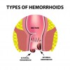 Haemorrhoids (Piles) (4)