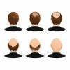 Hair Loss (1)